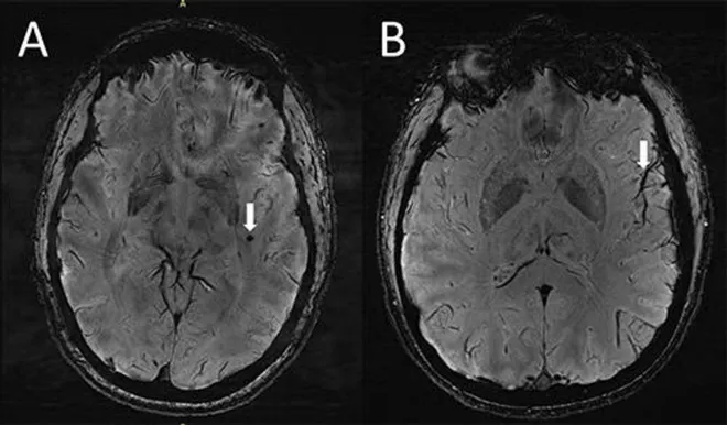 Scan Shows how Migraine Affects the Brain