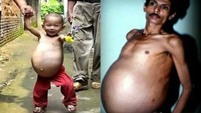 Weird: Man Swallowed Twin for 36 Years